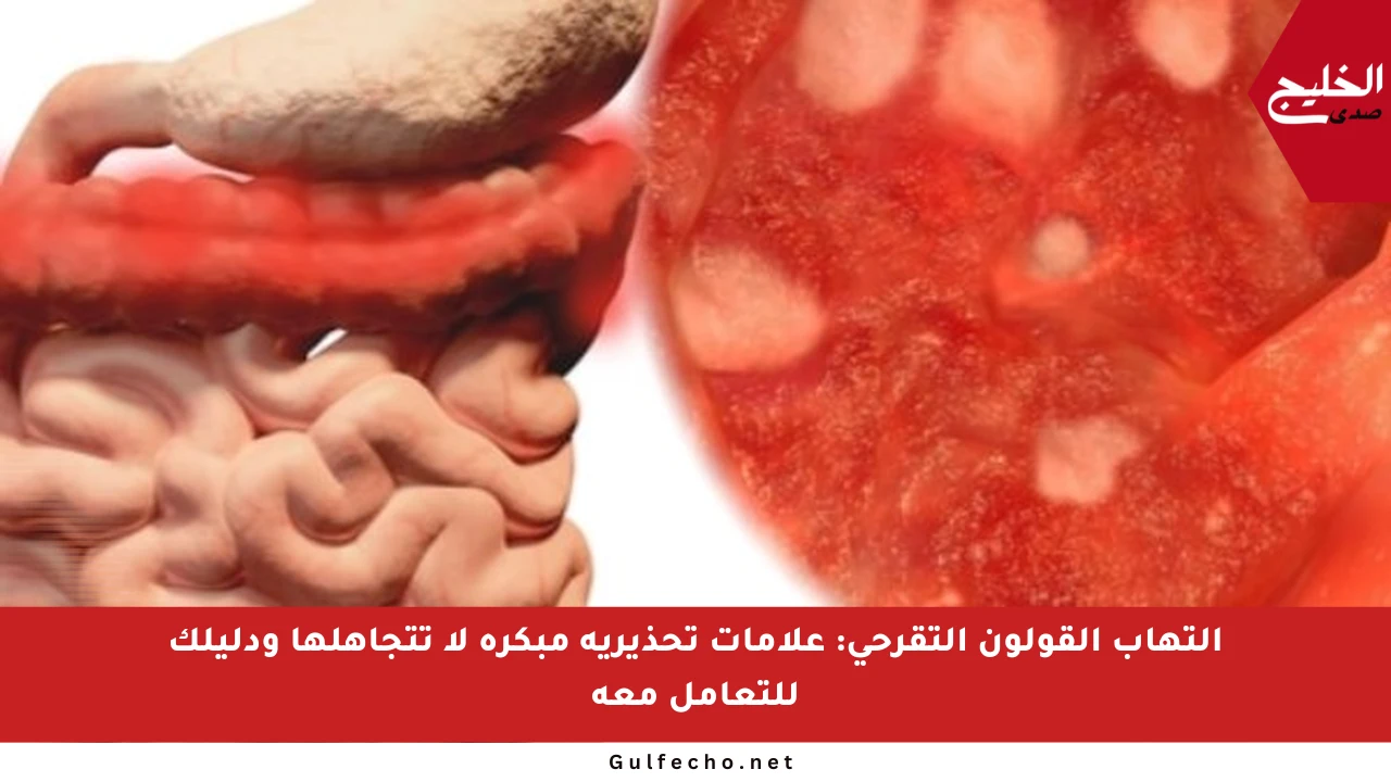 التهاب القولون التقرحي: علامات تحذيرية مبكرة لا تتجاهلها ودليلك للتعامل معه